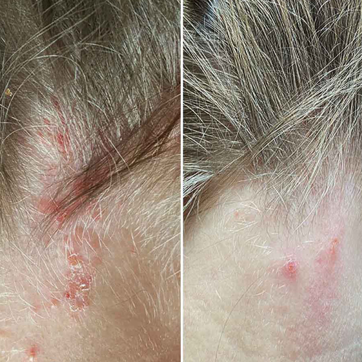 Szampon Healpsorin