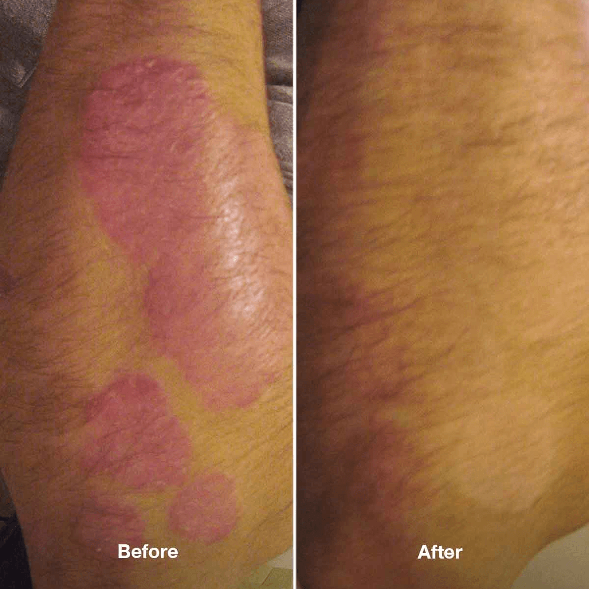 Balsam Emolientowy Healpsorin