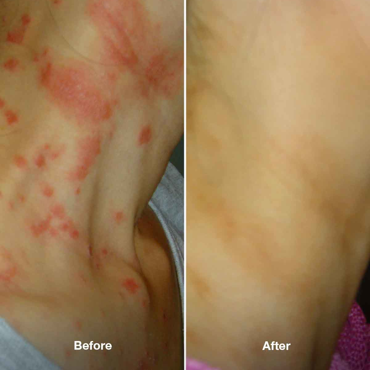 Zestaw Healpsorin No. 3