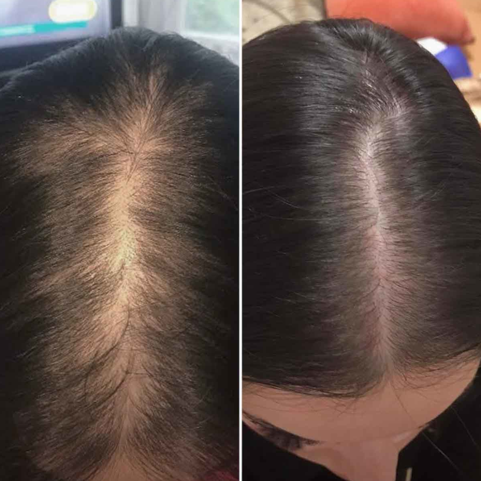 4-Stopniowy Zestaw HairLXR + Dodatkowe Serum